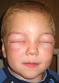 Angioedema